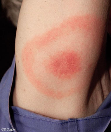 Lyme disease rash